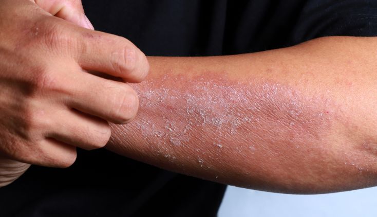 home remedy for eczema