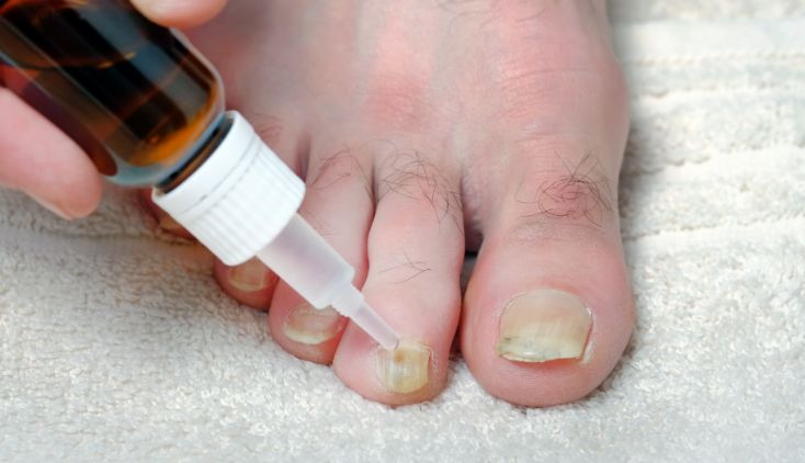 treatment for nail fungus